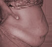 Tummy Tuck in Punjab