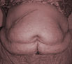 Tummy Tuck in India