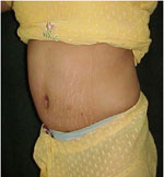 Liposuction treatment