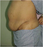 Liposuction treatment